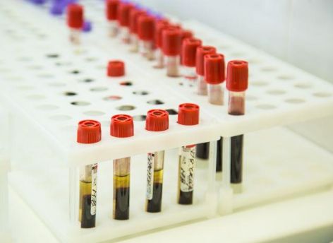 Заболеваемость ВИЧ в Югре снизилась на 11,2%