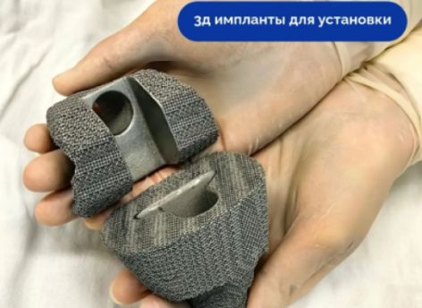 Сургутские врачи восстановили коленный сустав пациентки с помощью 3D-имплантов